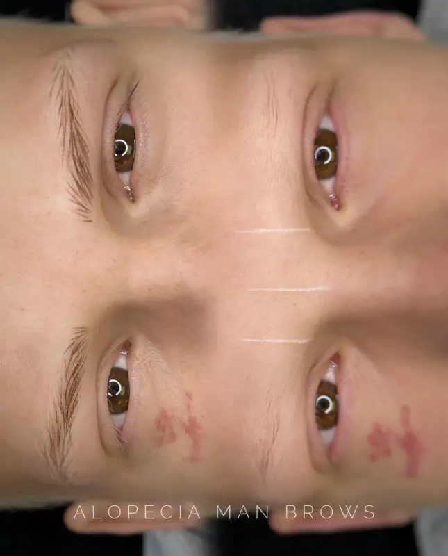 Hairstroke LaBrows Alopecia man